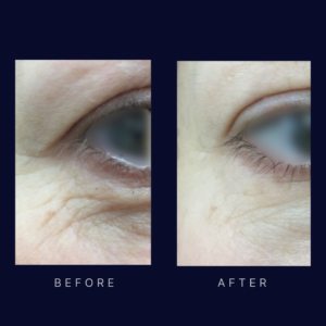 Laser eyelid lift and crows feet skin tightening (2)