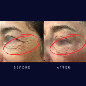 Laser eyelid lift and crows feet skin tightening