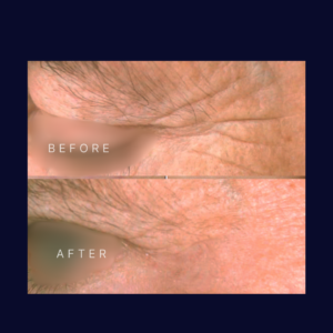 Laser eyelid lift and skin tightening