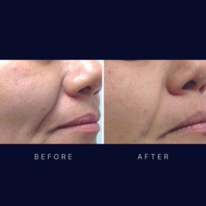 Laser face lift and skin tightening (2)