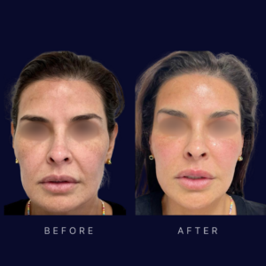 Laser facelift lift and skin tightening