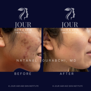 acne and acne scarring (2)