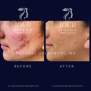 acne and acne scarring