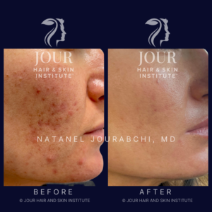 acne and acne scarring treatment