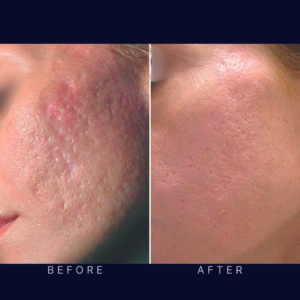 acne scar treatment