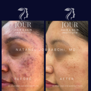 acne scarring