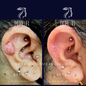 keloid and hypertrophic scar treatment