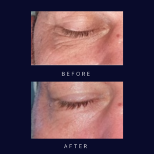 laser eyelid lift and crows feet removal