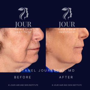 laser face and neck lift with skin tightening