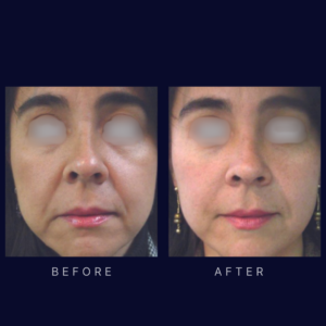 laser face lift and skin tightening