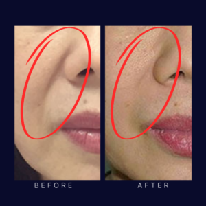 laser face lift and tightening (2)