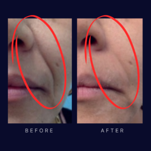 laser face lift and tightening