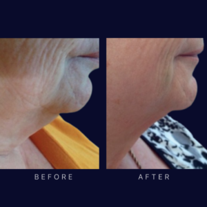 laser neck lift and tightening (2)