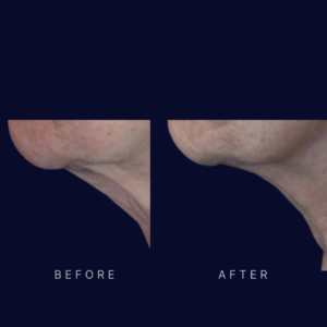 laser neck lift and tightening