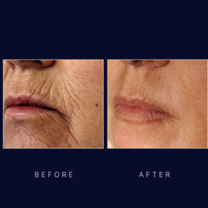 laser skin resurfacing and skin tightening