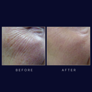 laser skin resurfacing and skin tightening