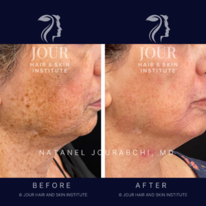 laser skin resurfacing, sun spot and pigmentation removal