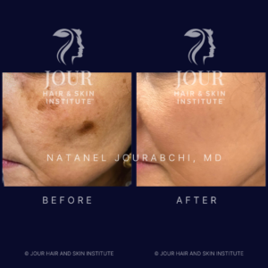 melasma hyperpigmentation