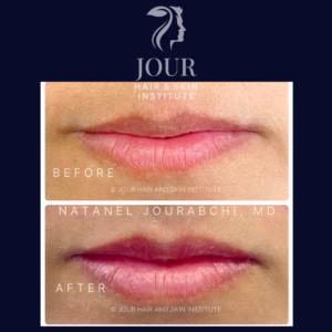 non-invasive lip rejuvenation and plumping (2)