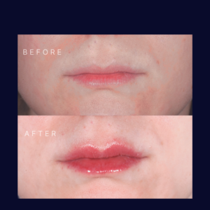 non-invasive lip rejuvenation and plumping (3)