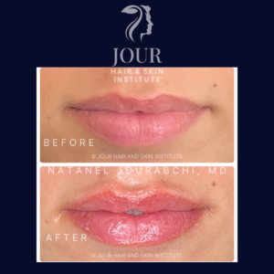 non-invasive lip rejuvenation and plumping