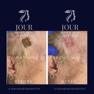 seborrheic keratoses