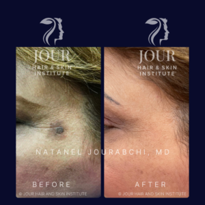 sunspot and pigmentation removal