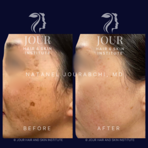 sunspots pigmentation and melasma