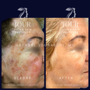 sunspots pigmentation and melasma (2)