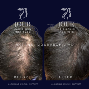 AGA - Mens Androgenetic alopecia