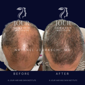 Androgenetic alopecia_1 - Male pattern hair loss