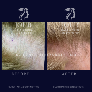 FFA Frontal fibrosing alopecia