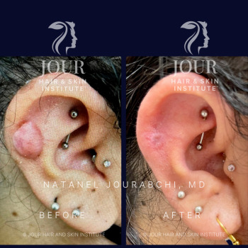 keloid and hypertrophic scar treatment